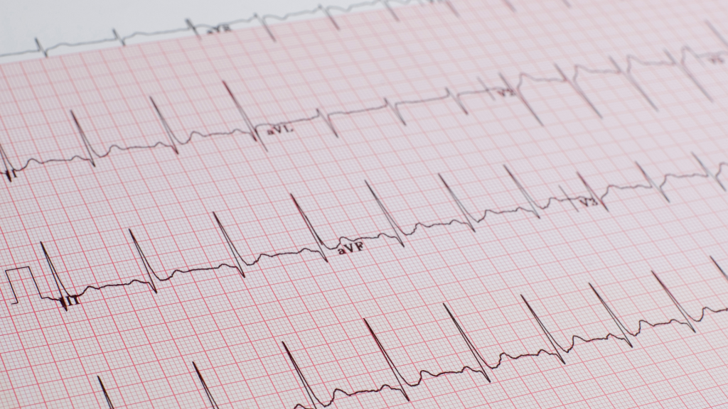 Los diferentes filtros de ECG que dispone Dinbeat UNO